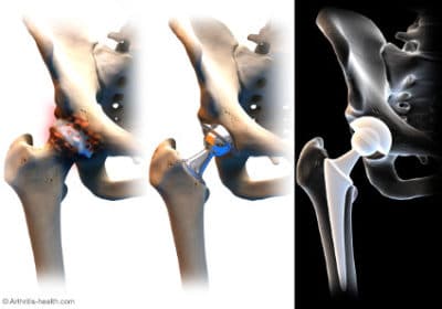 Joint replacement answers 4 Hip replacement