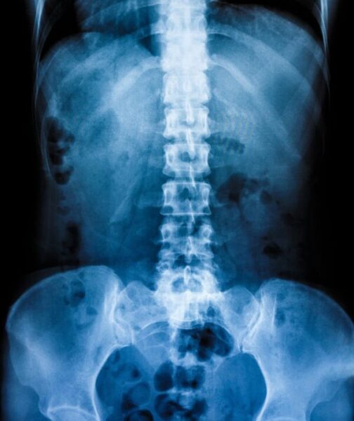 X-ray of spine and pelvis