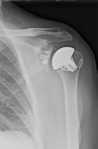 What you need to know: joint replacement surgery 2 Joint replacement surgery