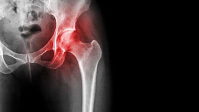 Is Your Hip Pain Serious?