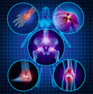 Post-traumatic arthritis 2 Post-traumatic arthritis