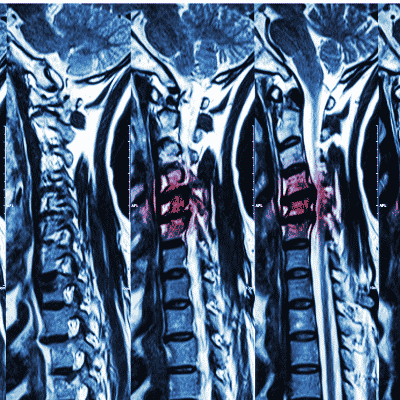 Cervical disc replacement