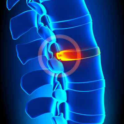 Advances in minimally invasive spine surgery 3 Illustration of a spine in blue with injured spot in red, representing spine surgery